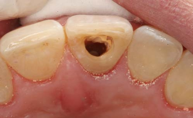 牙齿根管治疗 (49)