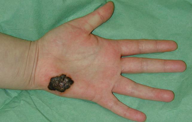 黑色素瘤典型早期图片