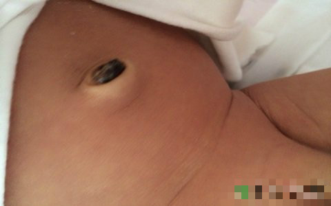 新生儿肚脐脱落图 (4)
