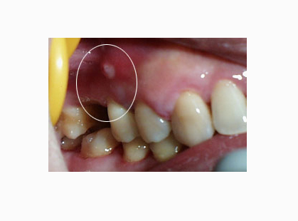 智齿冠周炎脓肿图片 (1)