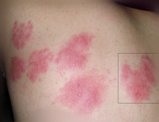 链球菌感染红疹图片图片