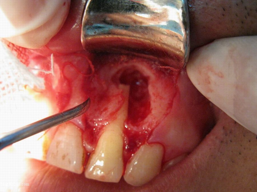 牙根尖周炎瘘管图片图片
