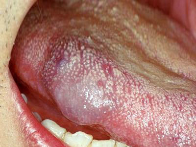 舌头上溃疡舌癌图片