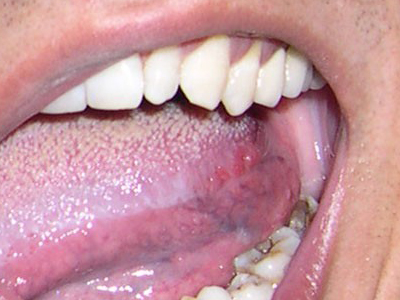 舌癌边缘早期图片自检图片