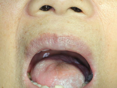 舌头两侧溃疡舌癌图片