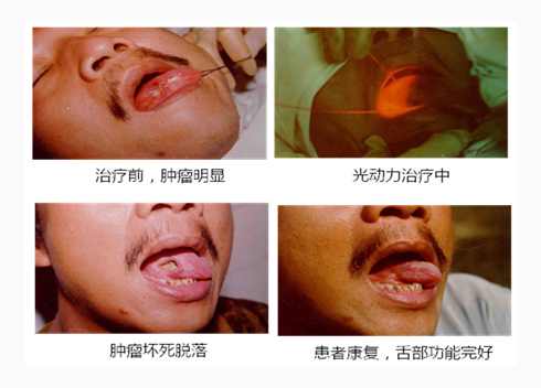 轻微舌癌图片 (5)