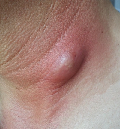 皮脂腺囊肿初期图片