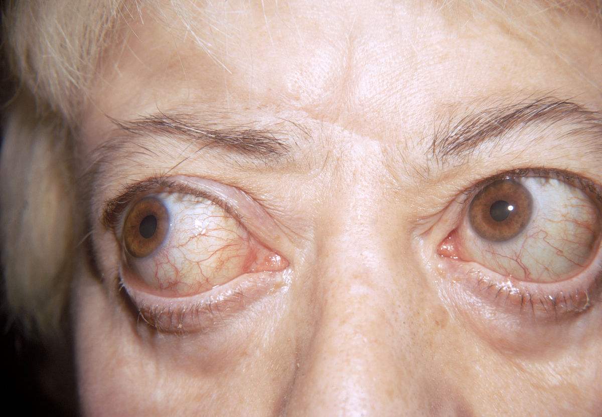 潘金眼的症状及治疗图片