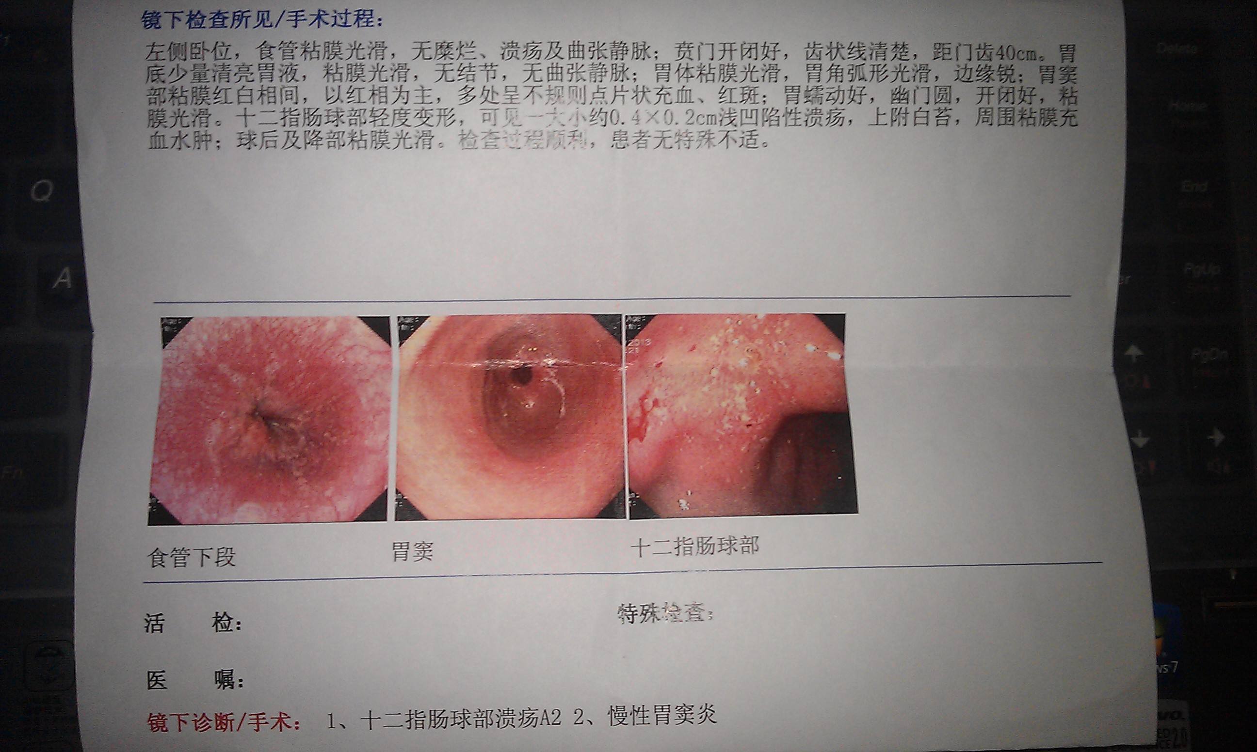 胃窦糜烂 (6)