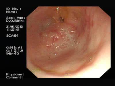 胃窦糜烂 (36)