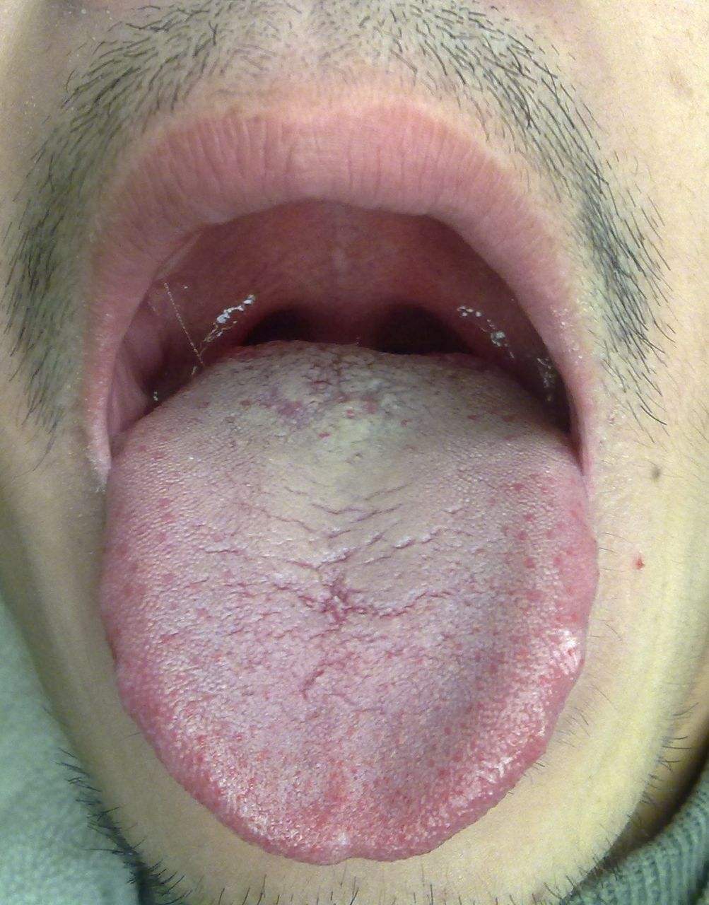 舌癌的图片大全 边缘图片