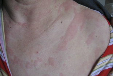 血清性荨麻疹症状图片图片