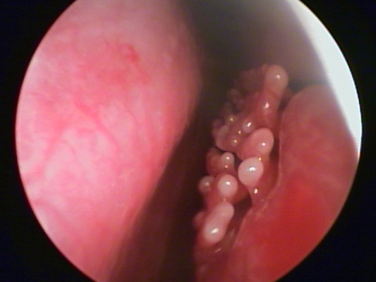 喉癌图片 (24)