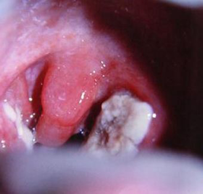 喉癌图片 (21)