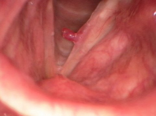 喉癌图片 (31)