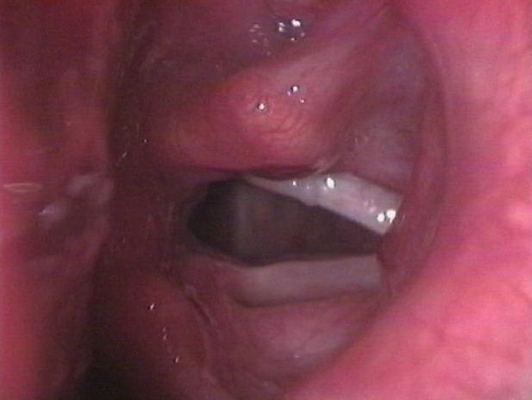 喉癌图片 (4)