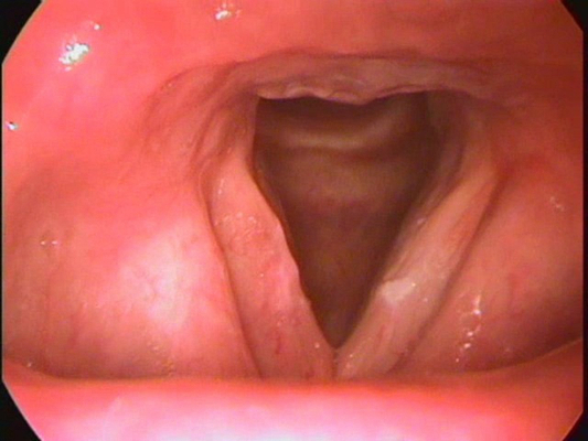 喉癌图片 (42)