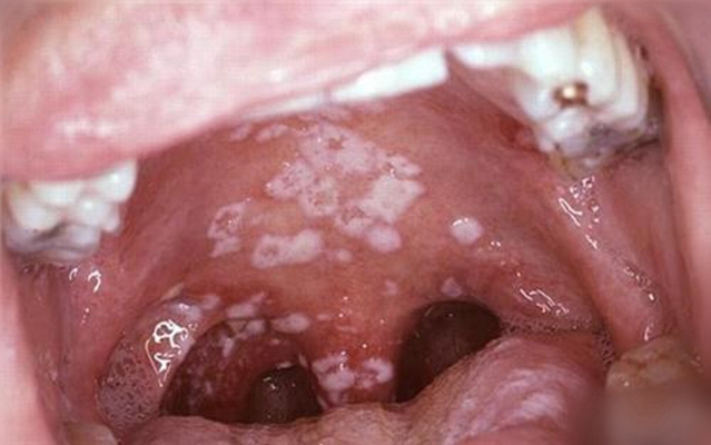 喉癌图片 (37)