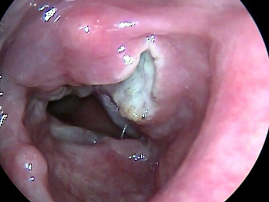 喉癌图片 (48)