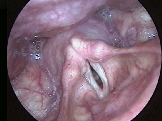 喉癌图片 (6)