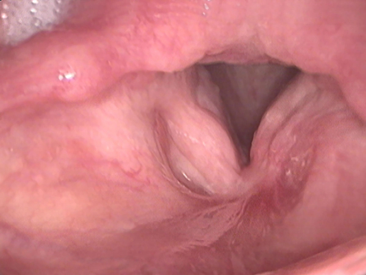 喉癌图片 (53)