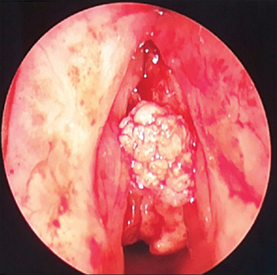喉癌图片 (9)
