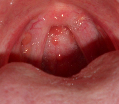 鼻咽癌早期图片图片