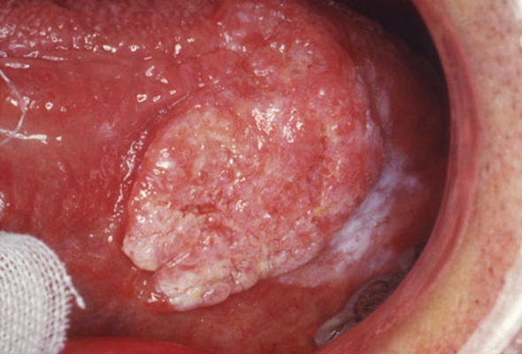 口腔癌的前兆 (32)
