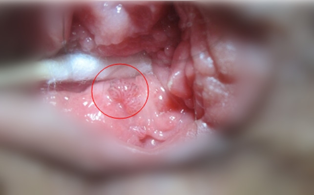 尖锐湿疣图片女图 (7)