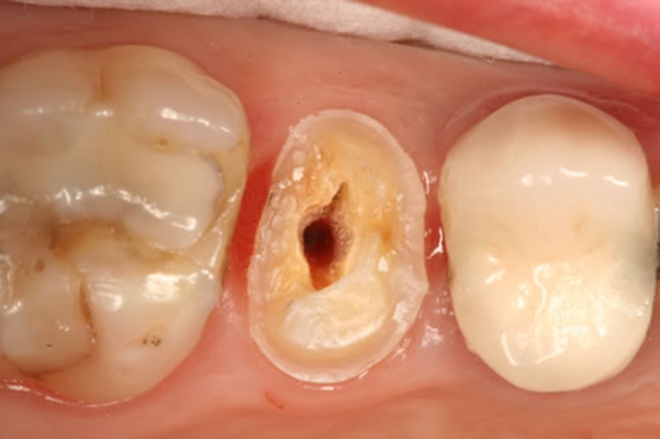 牙齿根管治疗 (44)