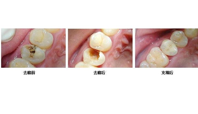 牙齿根管治疗 (7)