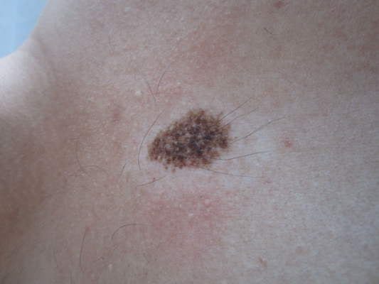 黑素瘤早期图片 (11)