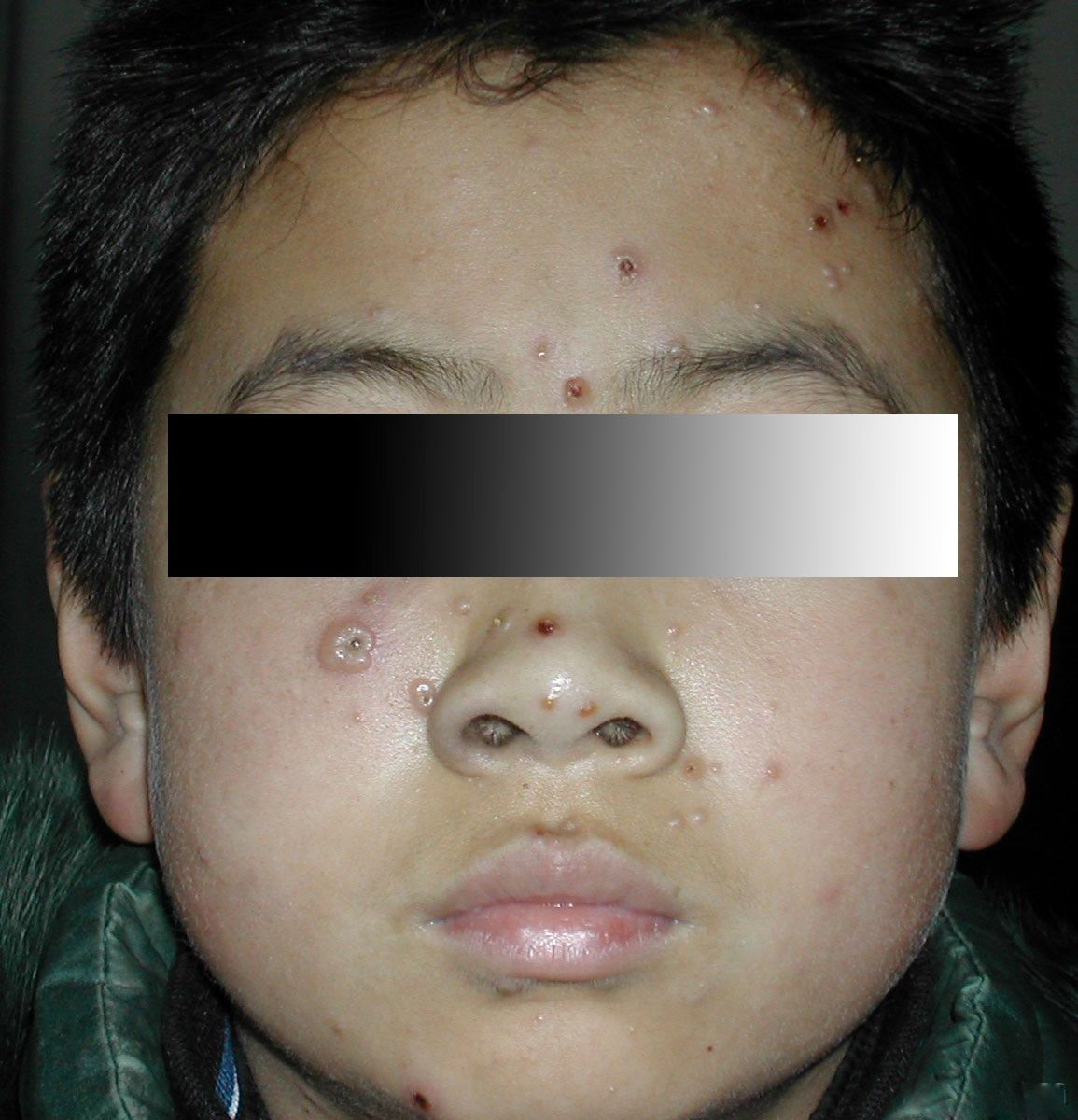 水痘的症状和治疗 一般几天能好 - 美容护肤 - 蓝灵育儿网
