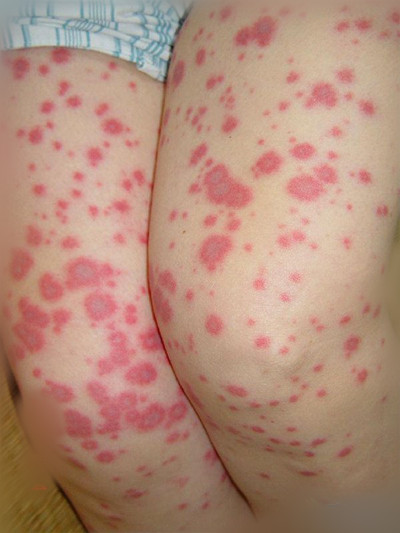 猩红热疹子图片 麻疹图片