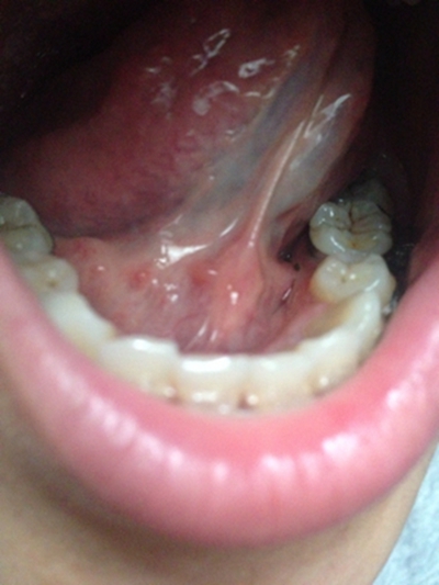 舌根疣体图片图片