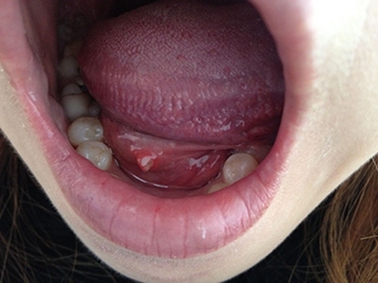 舌头接近喉咙长疙瘩图图片