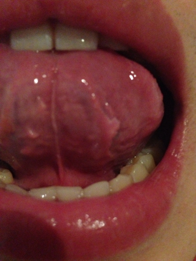 舌头上长红色肉粒图片图片