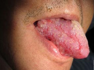 体内有癌舌头图片图片