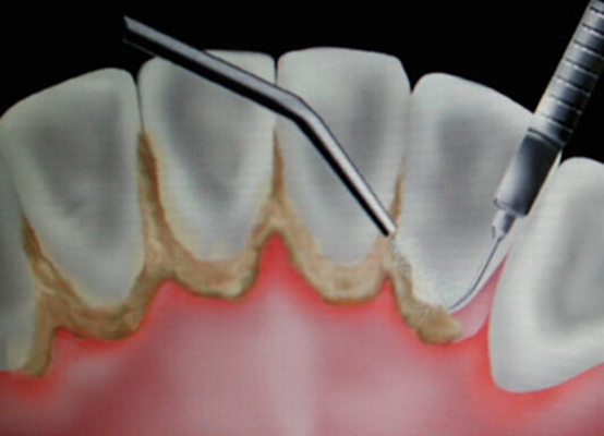 牙周袋(3)