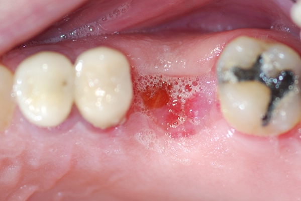 干槽症牙洞图片