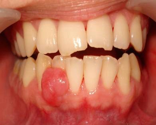 牙龈瘤与牙龈癌 溃疡图片