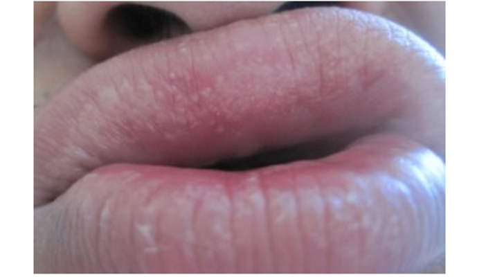 艾滋病早期嘴唇现状图片
