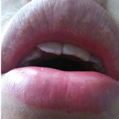 艾滋病人的嘴角图片图片