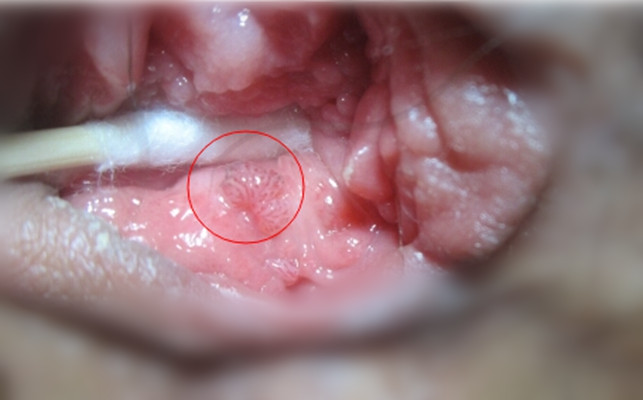 尖锐湿疣的早期症状 (7)