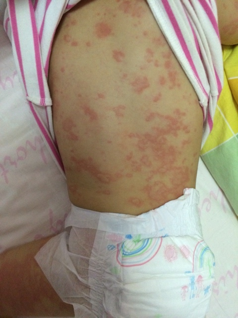 小儿荨麻疹图片和症状图片