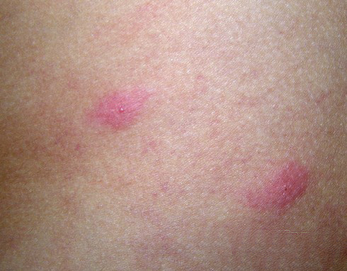 急性过敏性荨麻疹皮疹图片