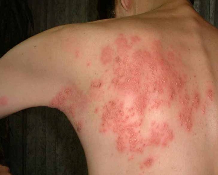 带状疱疹初期症状图片图片