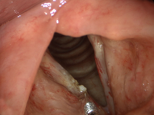 喉癌图片 (25)