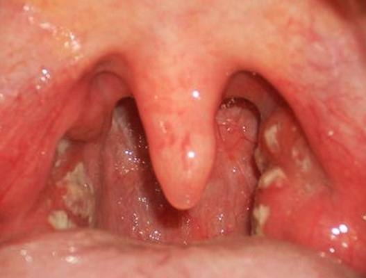 喉癌图片 (22)