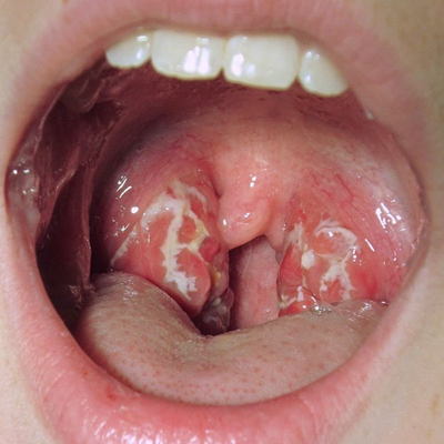 喉癌图片 (2)